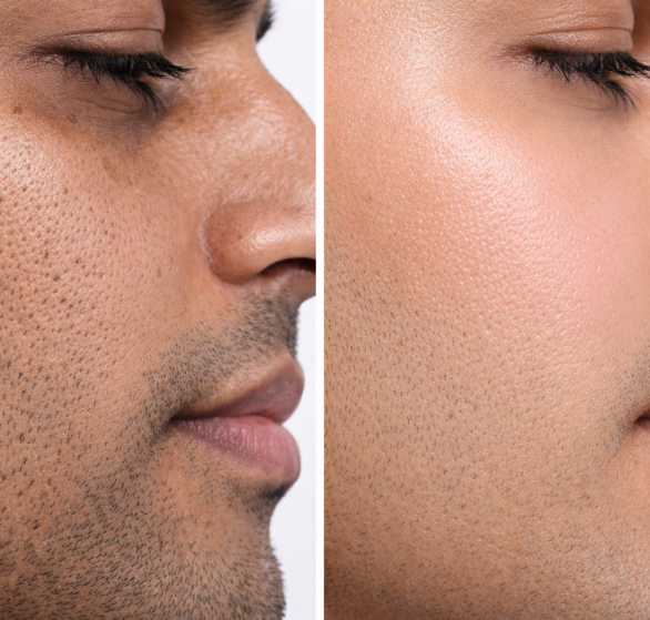 hydrafacial basic